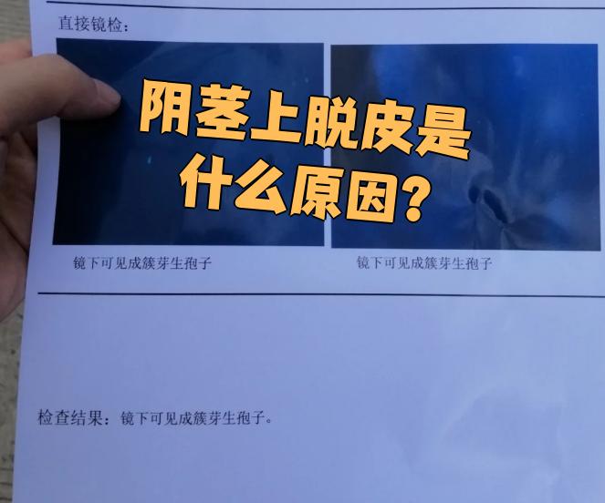 阴茎脱皮可能由多种原因引起,常见的有下面几种