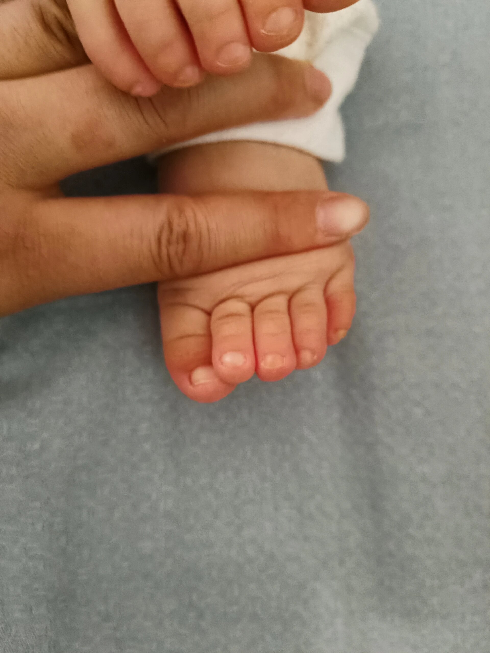 一岁宝宝拇指外翻