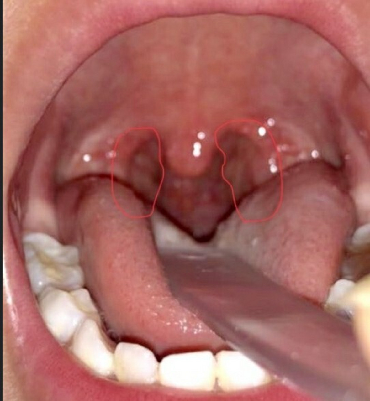 宝宝扁桃体肥大居家自测指南 俗话说得好,有图才有真相,关于扁桃体