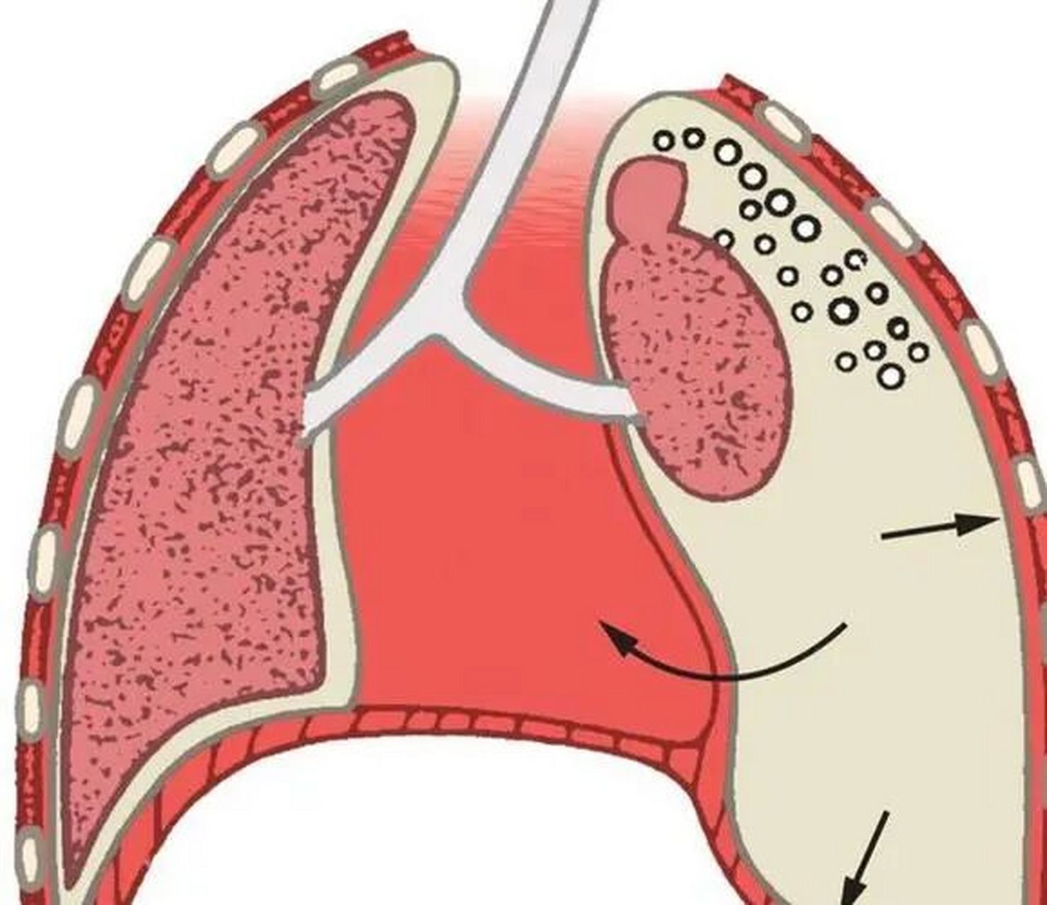 气胸 症状的轻重取决于起病快慢,肺压缩程度和肺部原发疾病的情况.