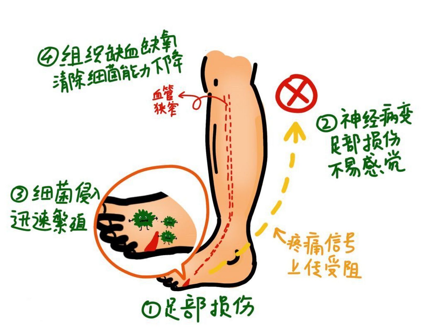 从恐惧到了解 首先,糖尿病足是糖尿病引发的一系列足部问题,从轻度