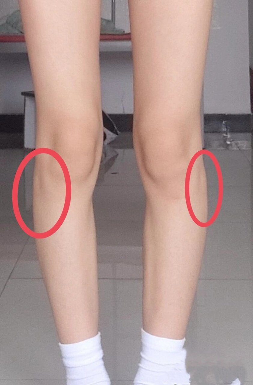 鉴定网络热门腿型～胫骨平台外移 今日鉴定:胫骨平台外移.