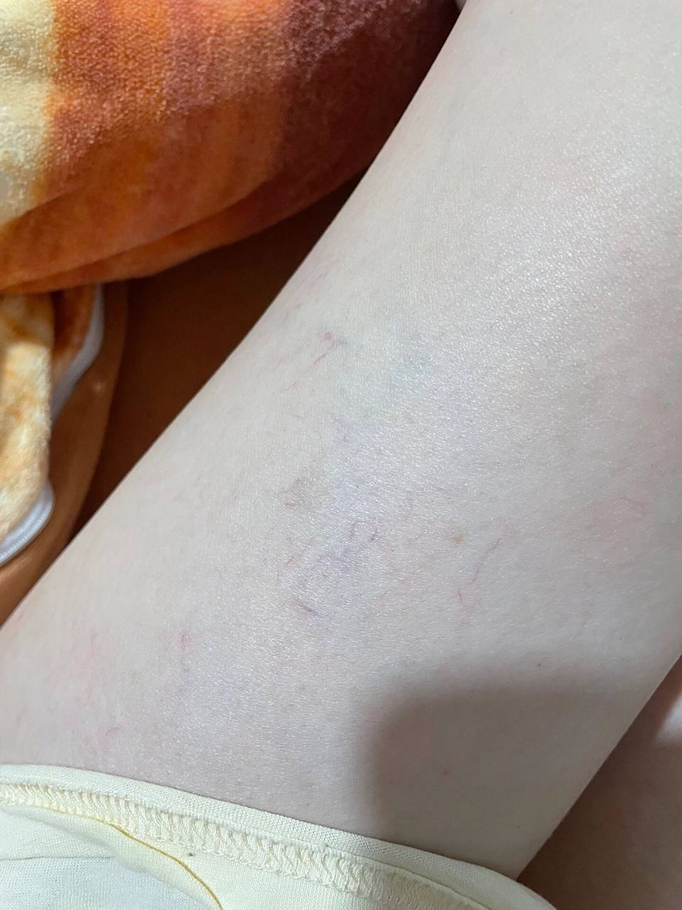 腿上突然出现了很多红血丝 不知道是不是肥胖纹,近两年胖的有点嚣张