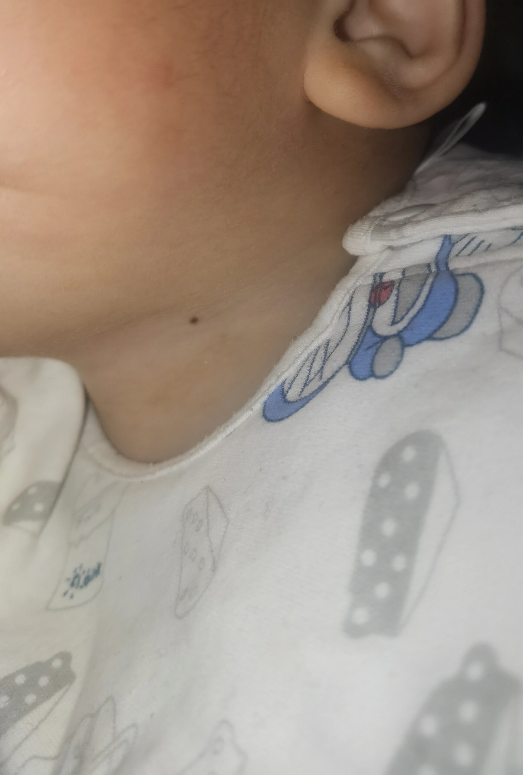 一岁宝宝脖子有小黑点