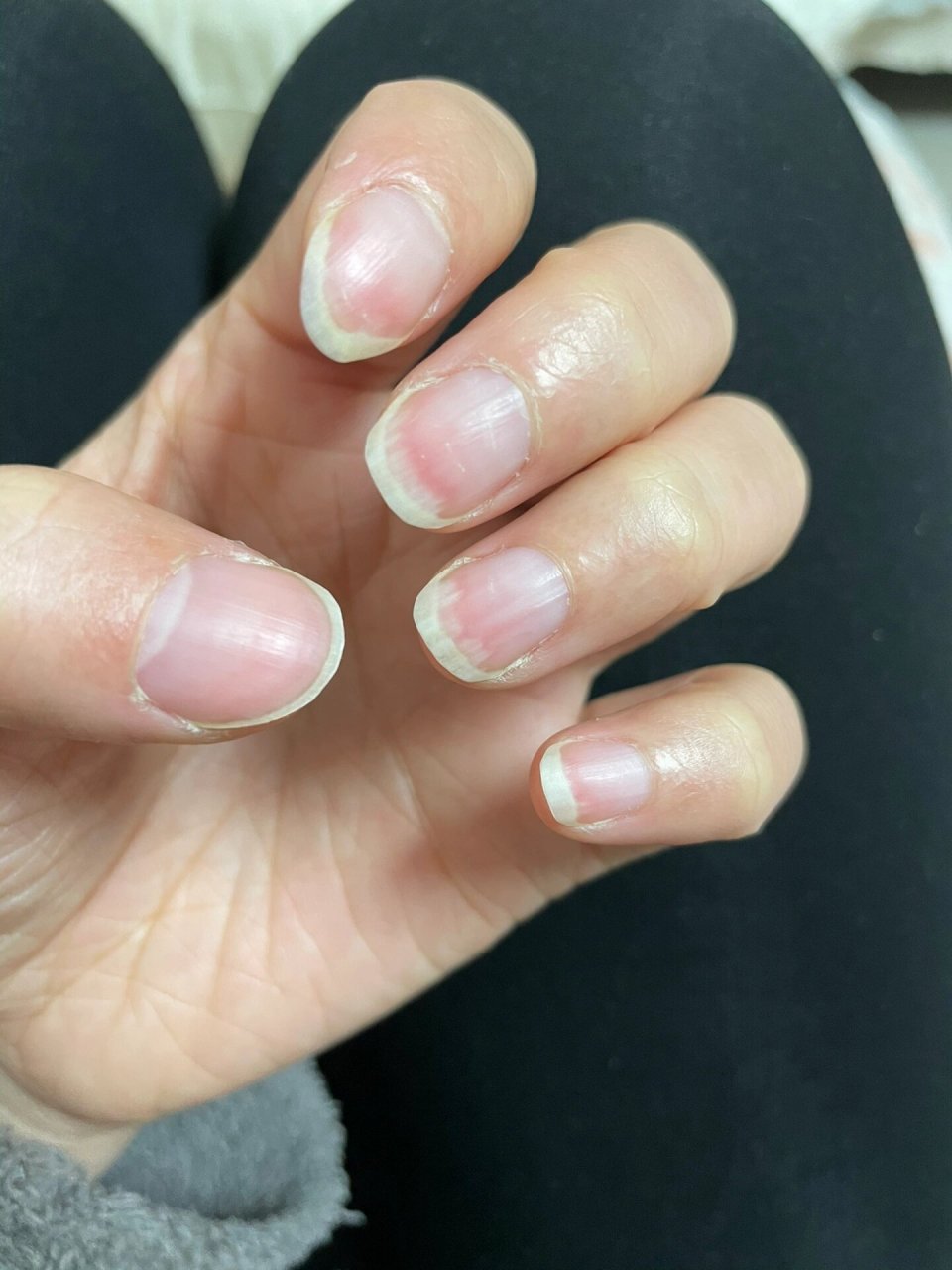 指甲变白是什么原因呢?