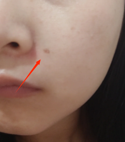 激光点痣会复发吗?