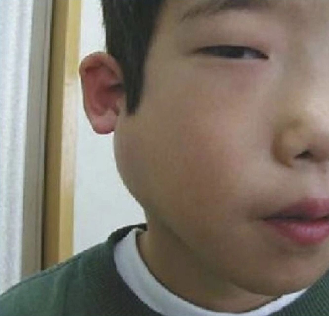 儿童常见传染病之流行性腮腺炎篇 流行性腮腺炎也叫"痄腮",俗称"大