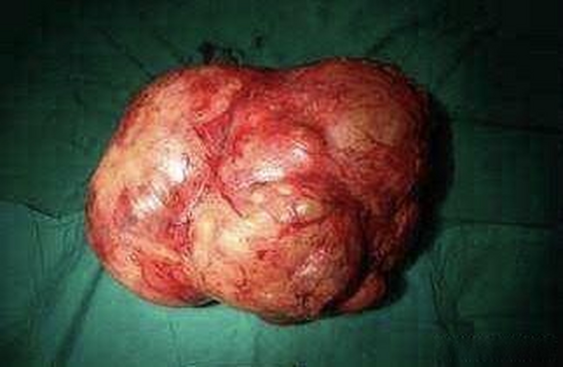 1,乳腺叶状肿瘤一般体积较大,单发,少 见,仅占乳腺肿瘤的0.3% -0.