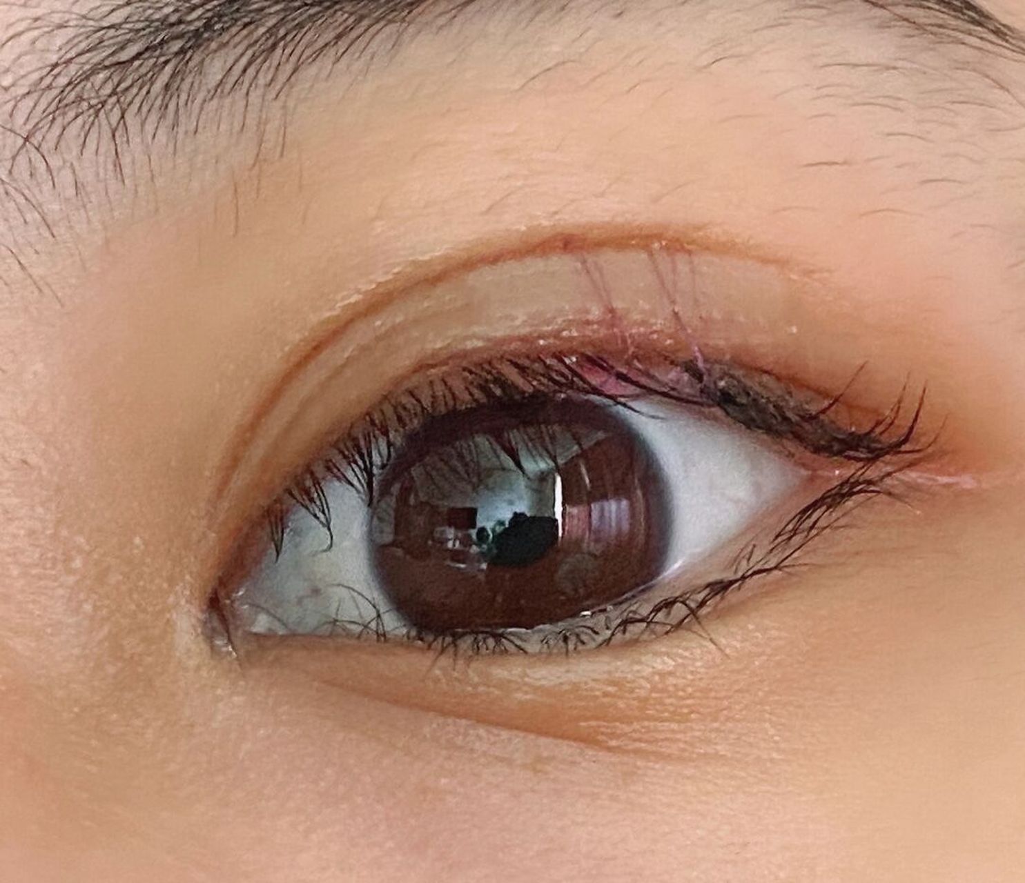 上眼睑痣 这颗痣长在右边上眼睑中间,因为害怕做掉之后眼眶会有缺损