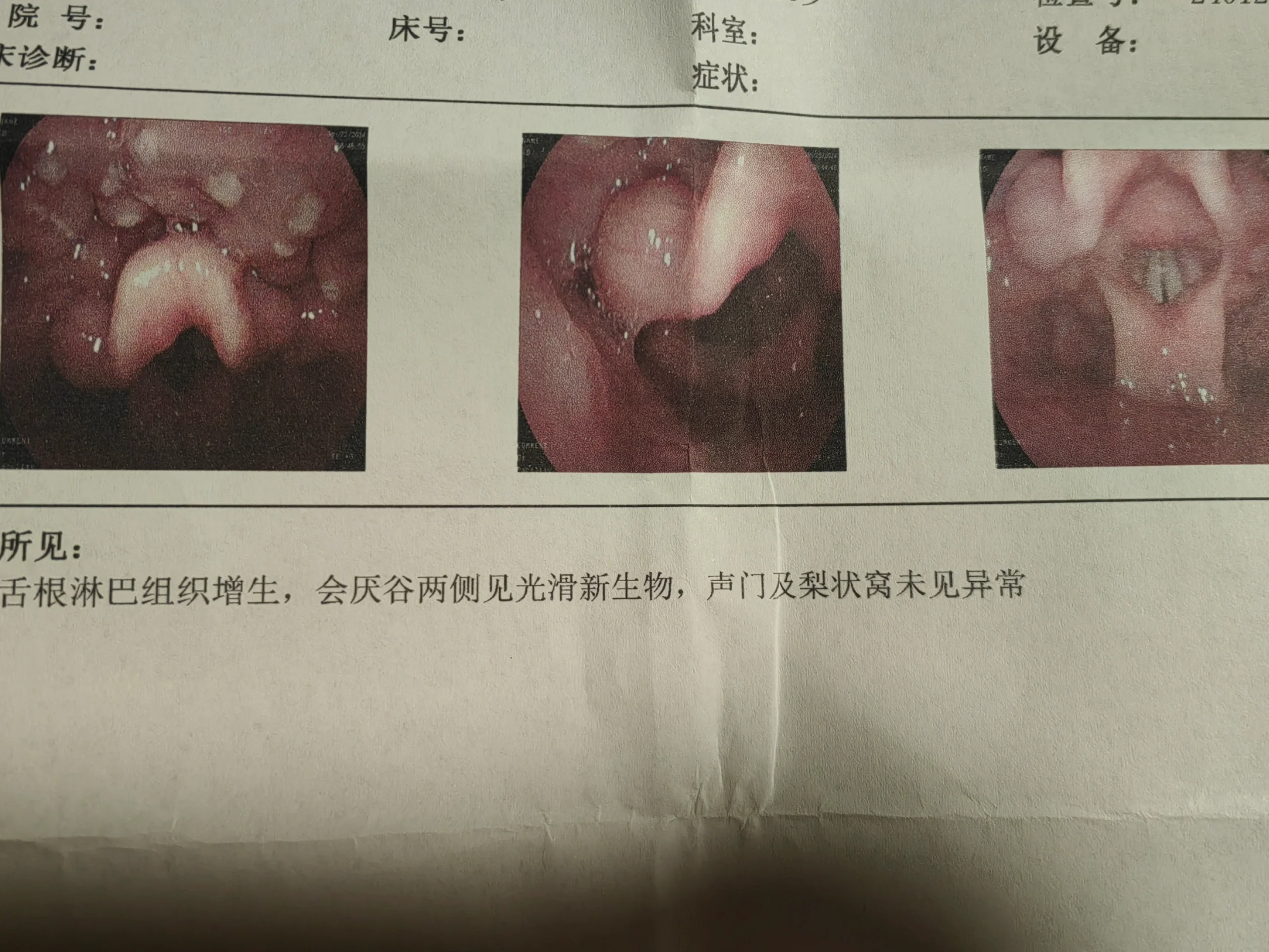 会厌囊肿手术过程图片图片