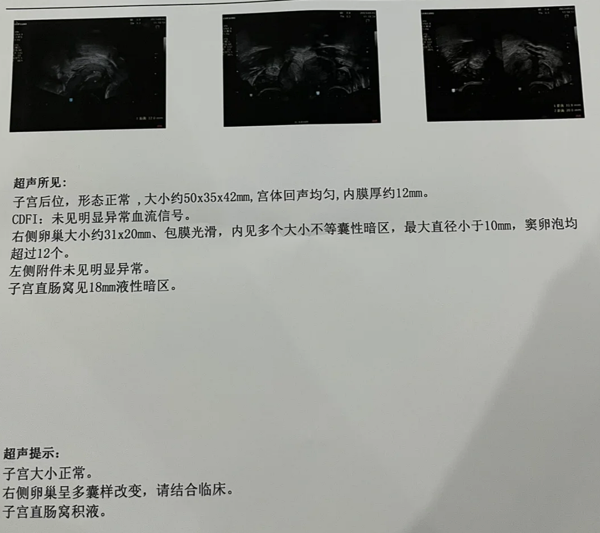 多卵巢怎样检查(卵巢怎样检查才是准确)