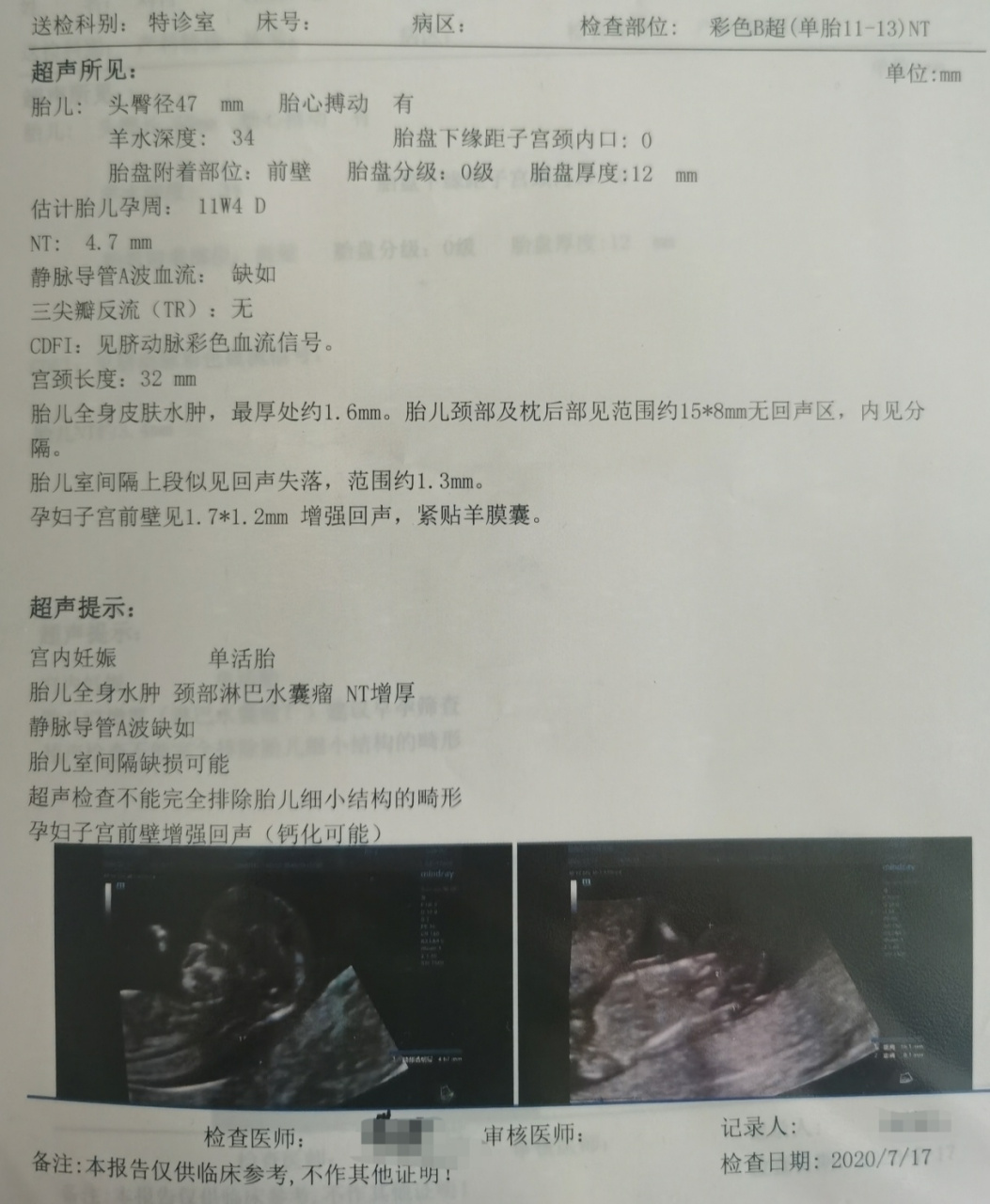 nt增厚胎儿全身水肿,不要轻易放弃!