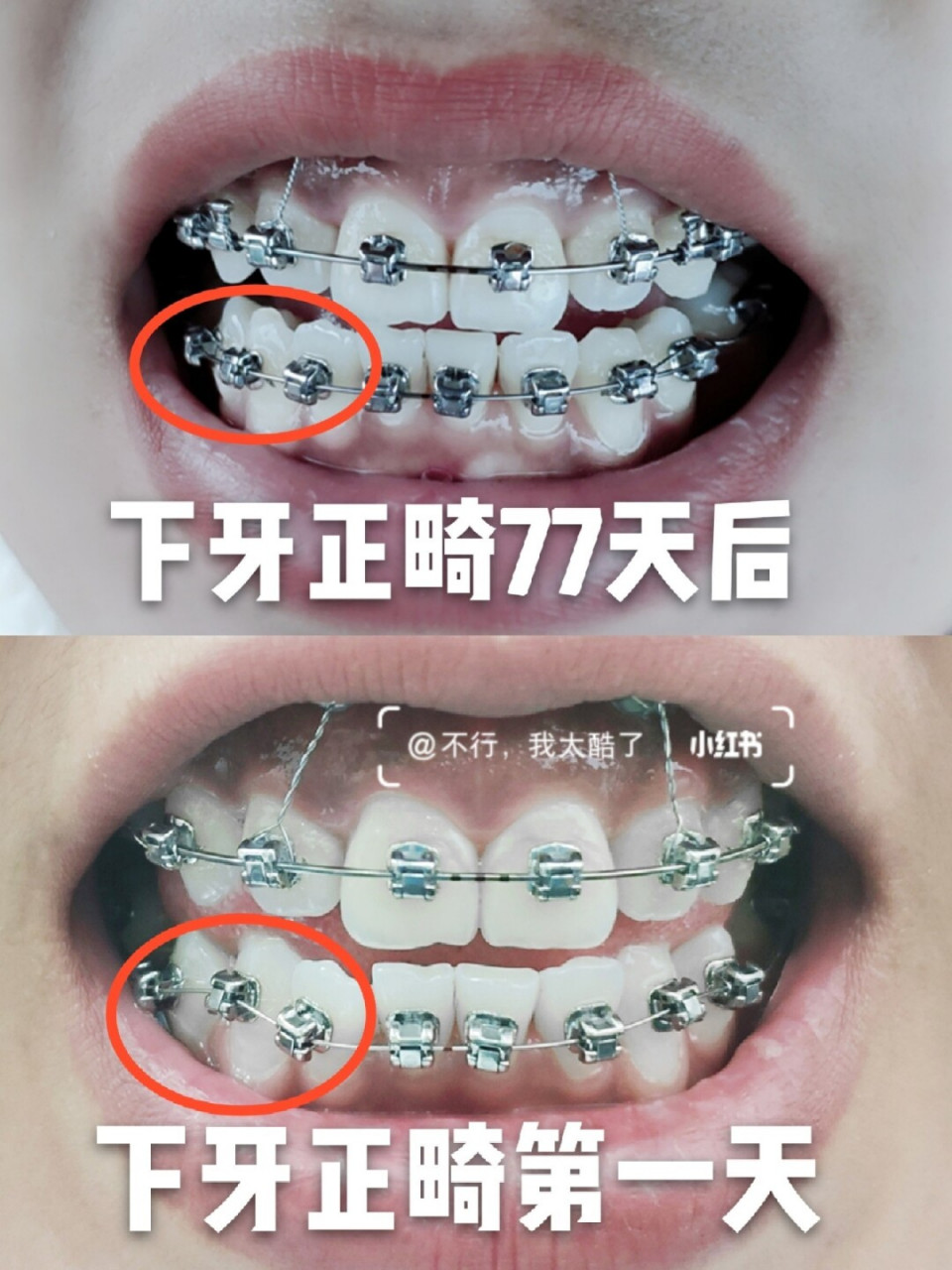 正畸(10)下牙箍排齐争气啊 下牙箍钢丝在77天内换了3次, 最明显的钢丝