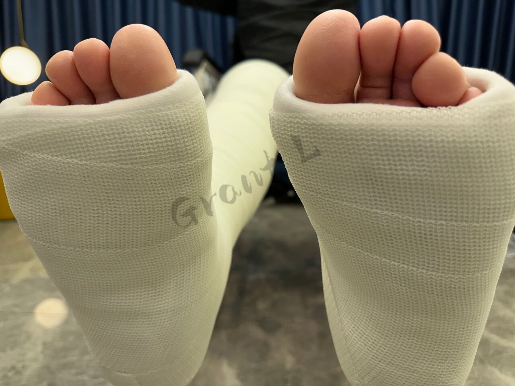 发两张单侧髋人字石膏的图 最近貌似又在一些奇奇怪怪的地方看到我的