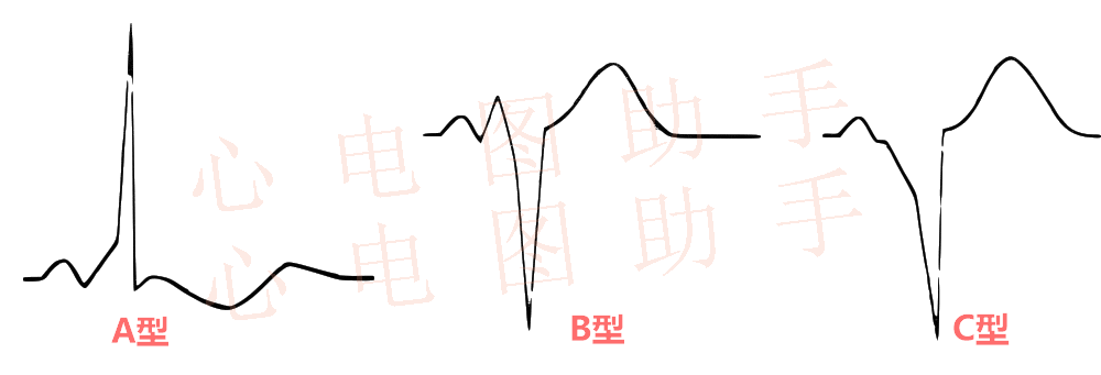 心室预激心电图图片