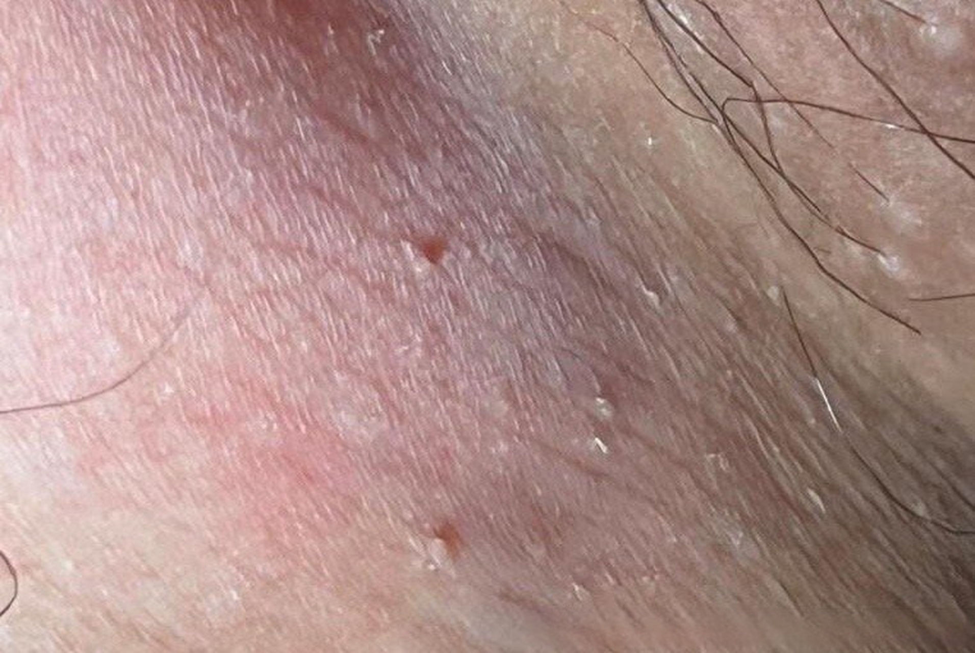 老高老高了的皮肤科##微博名医讲堂# 腹股沟长了两个小疙瘩,请问医生