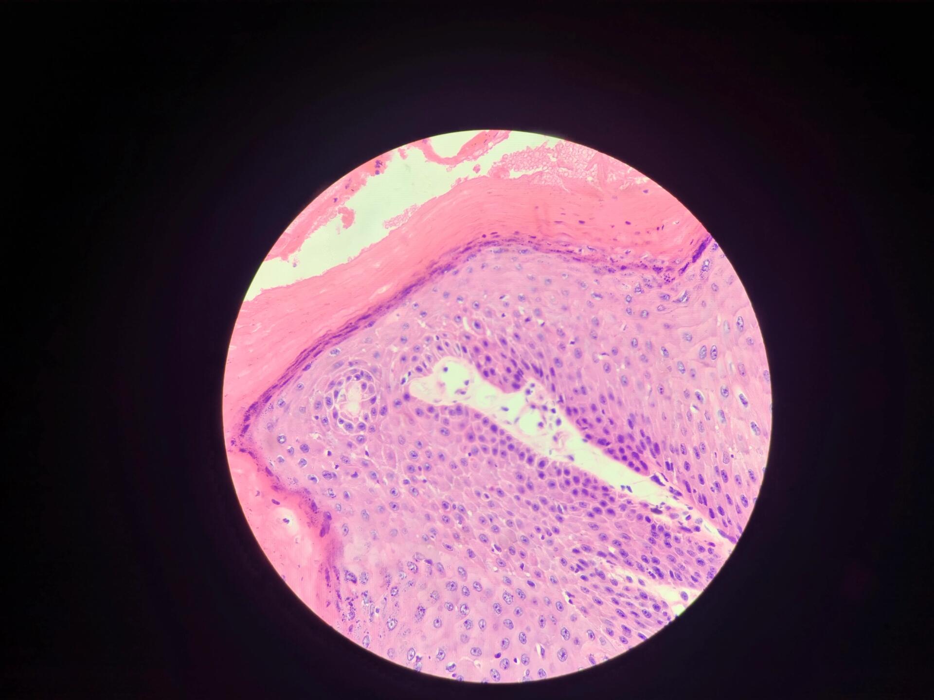 皮肤乳头状瘤 上课记录7115