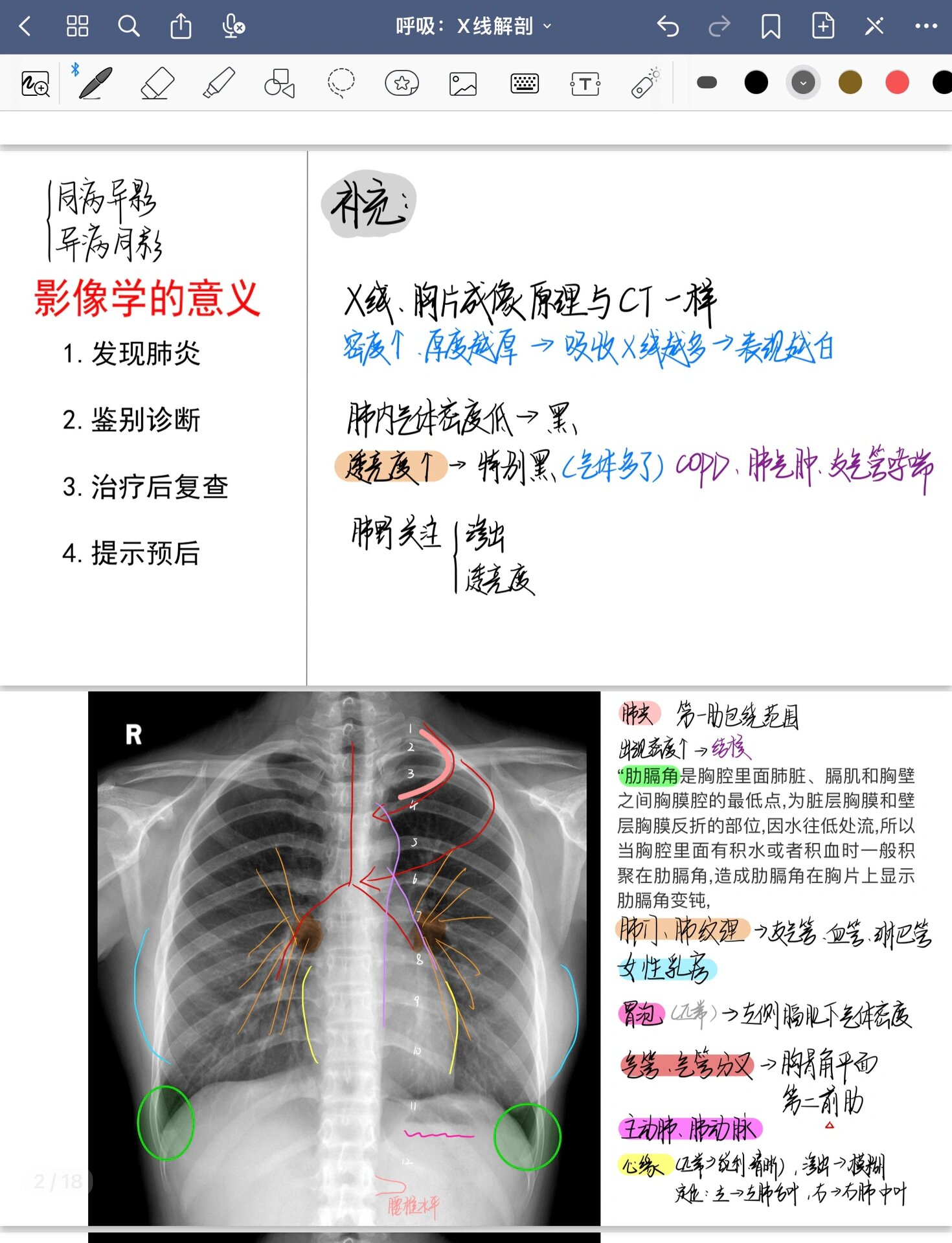 肺炎x光片图解图片