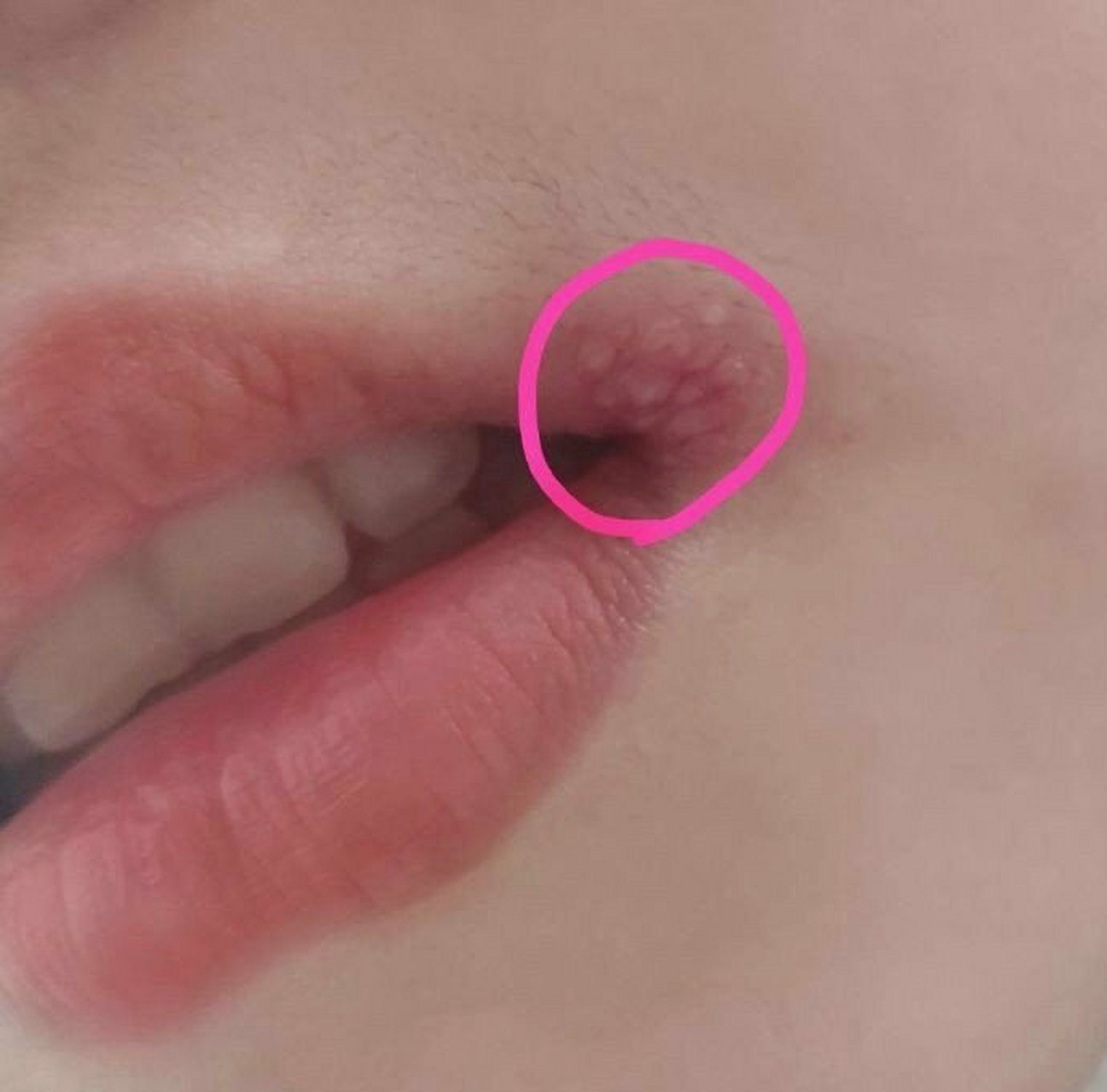 网友:女友午休起来就这样了,这嘴唇边是什么疙瘩呢?