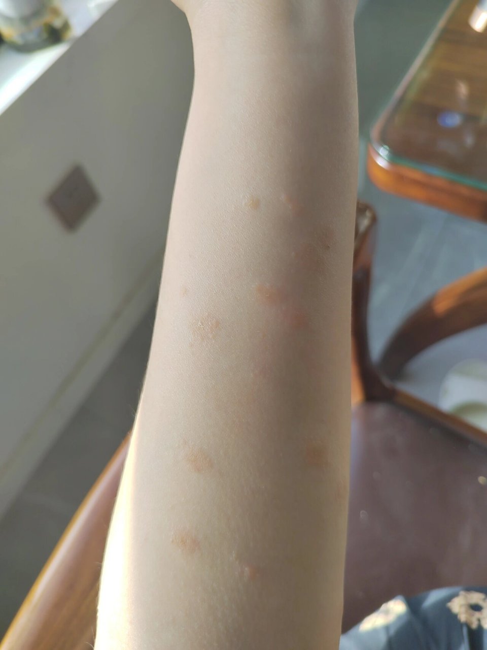 玫瑰糠疹开始消散了 阳过后就开始起疹子,以前从来没有皮肤问题.