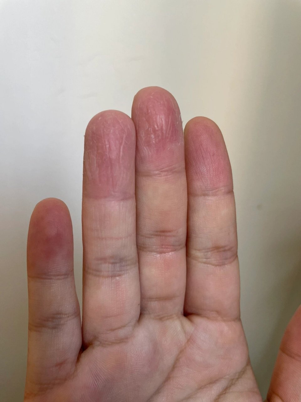 生完孩子后出现的这种情况,先开始一根手指后后来传染成两根,扒皮