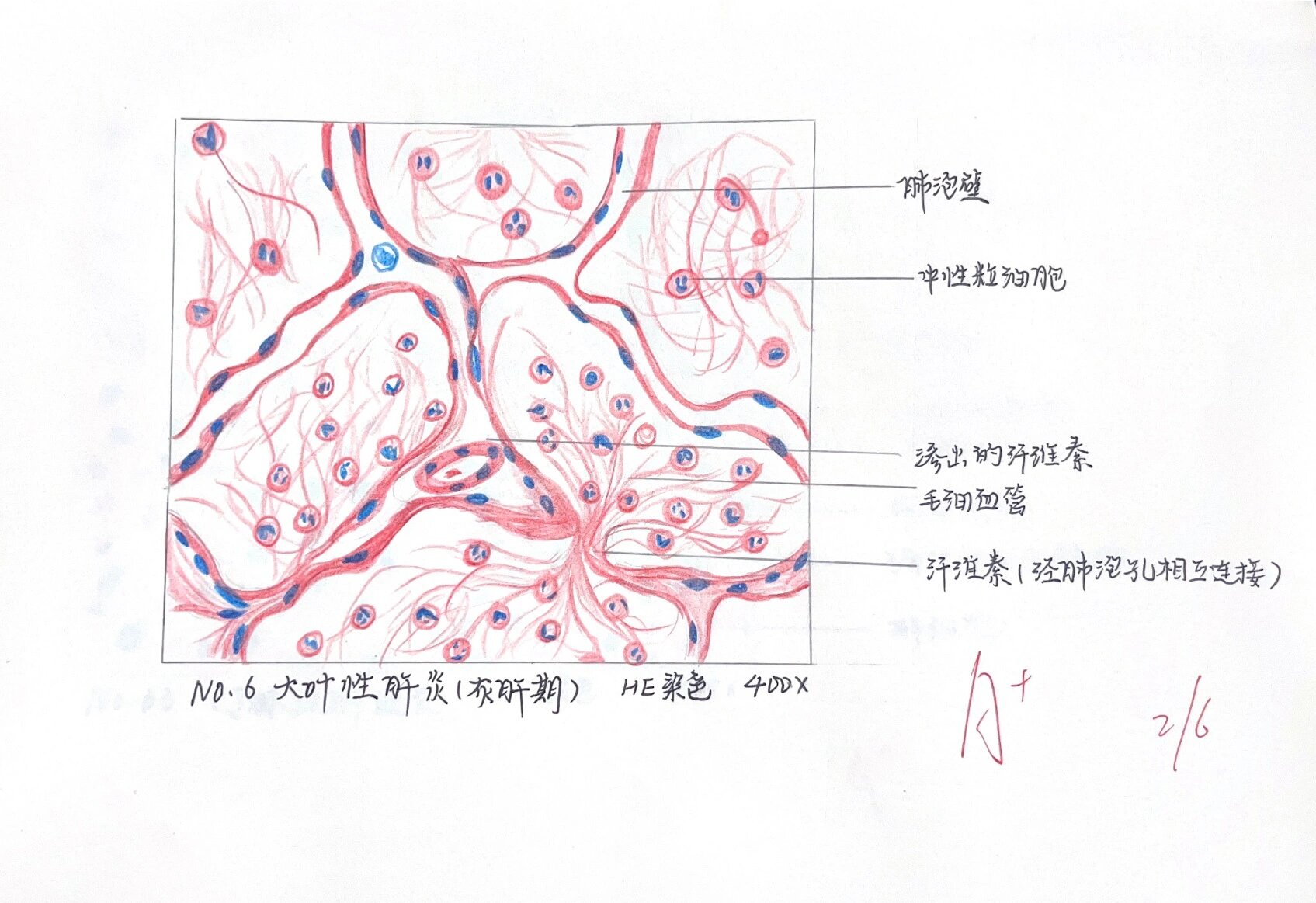 大叶性肺炎红肝期绘图图片