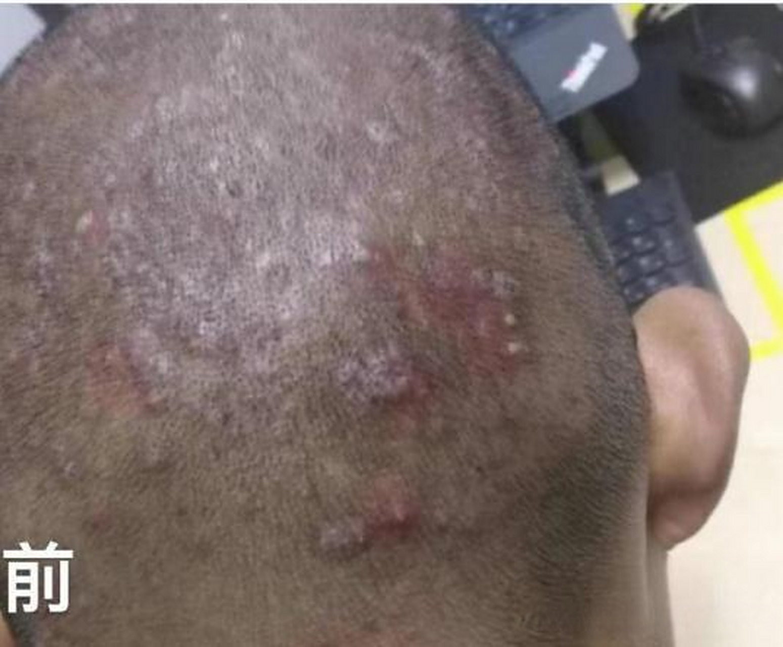 有没有人像他一样,头上长满了红疙瘩,又难受又抓狂,这是毛囊炎,要解决