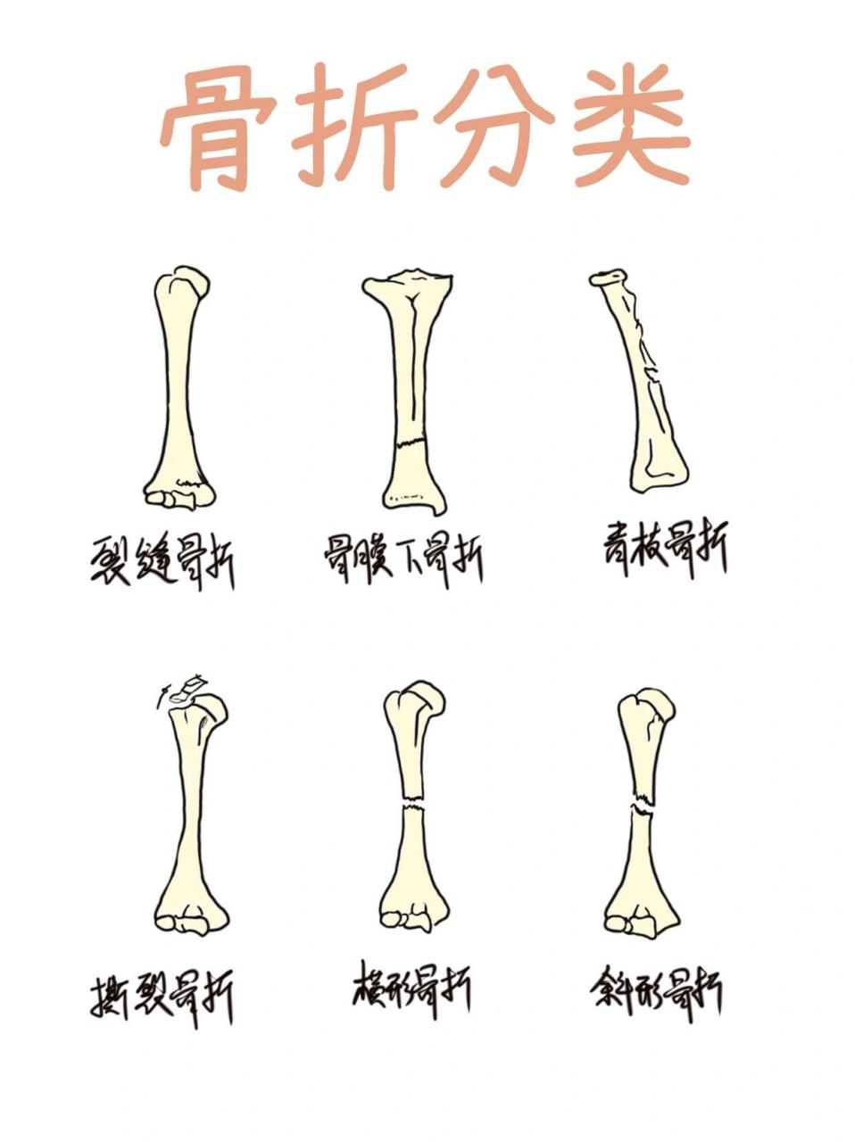 08笔记‖骨折分类 骨折分类你都了解嘛,赶紧学起来