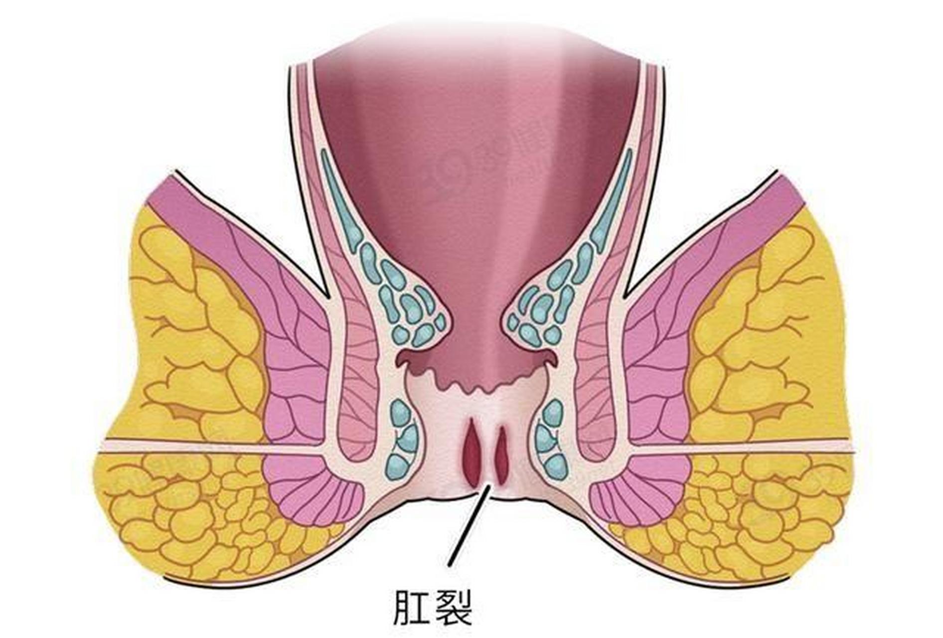 肛裂最真实图片图片