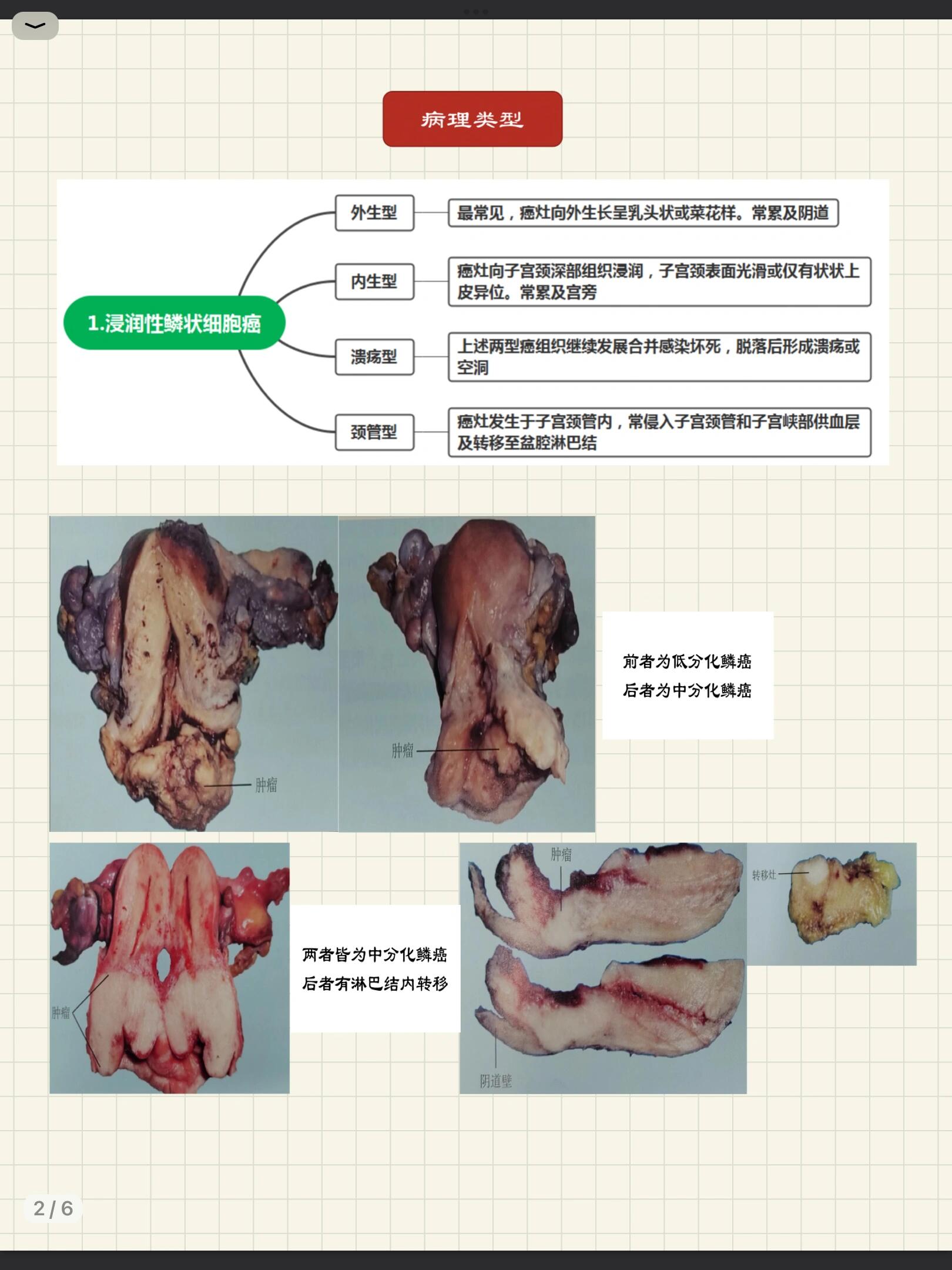 宫颈癌,也称为子宫颈癌,是发生在子宫颈部位的恶性肿瘤°,是女性生殖