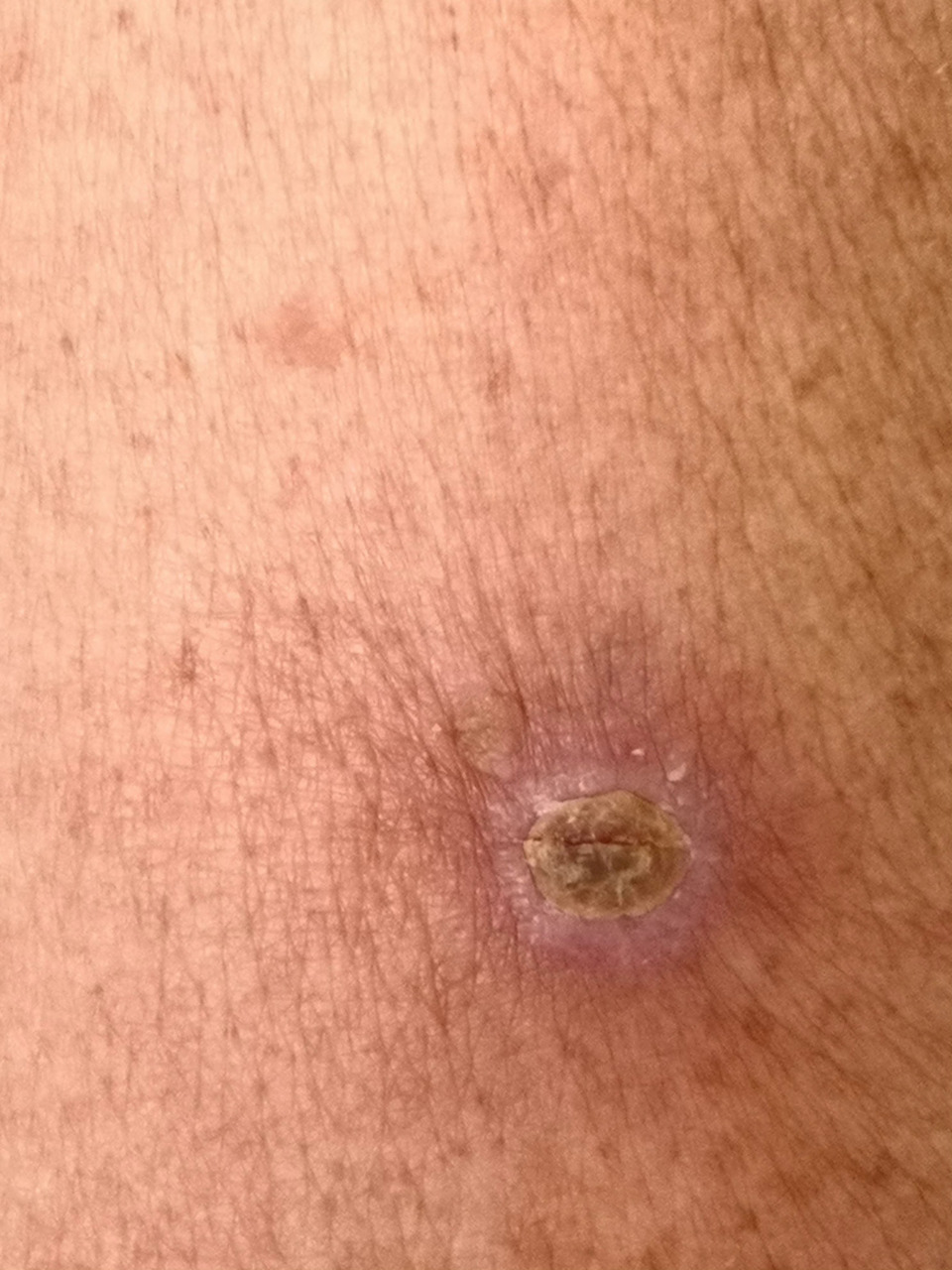 上肢皮肤增生物,活检高分化鳞状细胞癌.