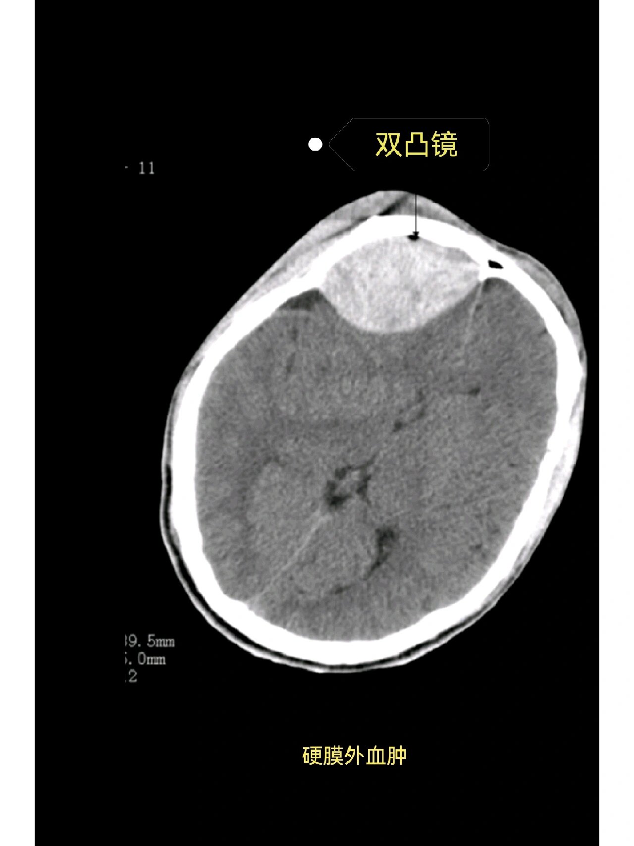 头皮血肿ct图片图片