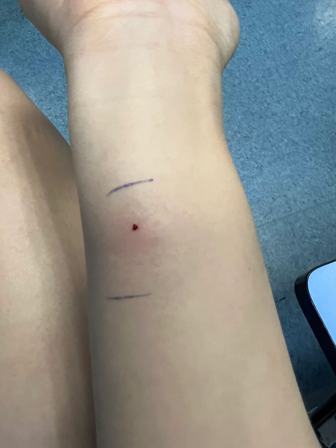 破伤风过敏了只能打破伤风球蛋白了