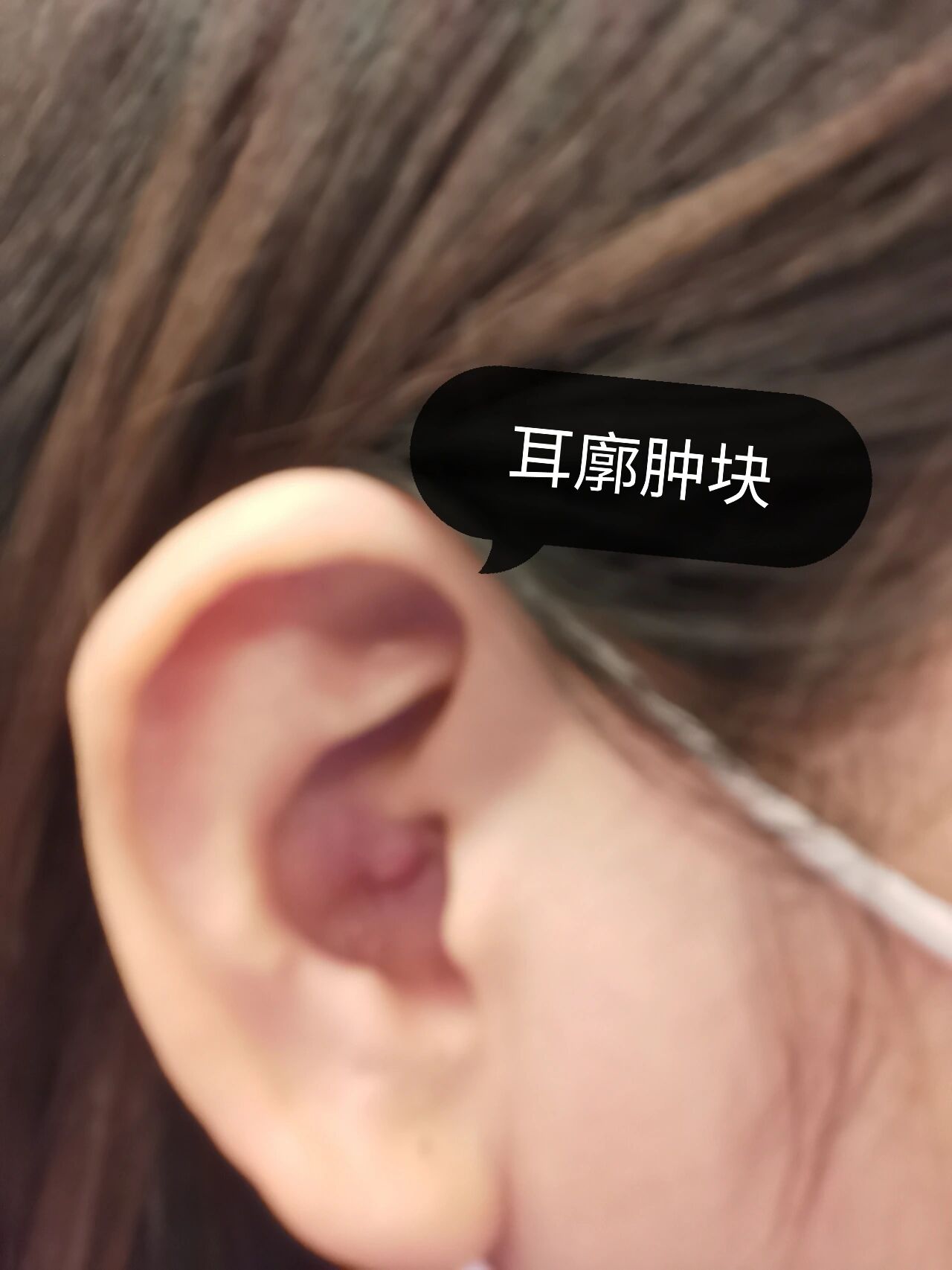 耳廓囊肿/肿块 不痛不痒不影响听力