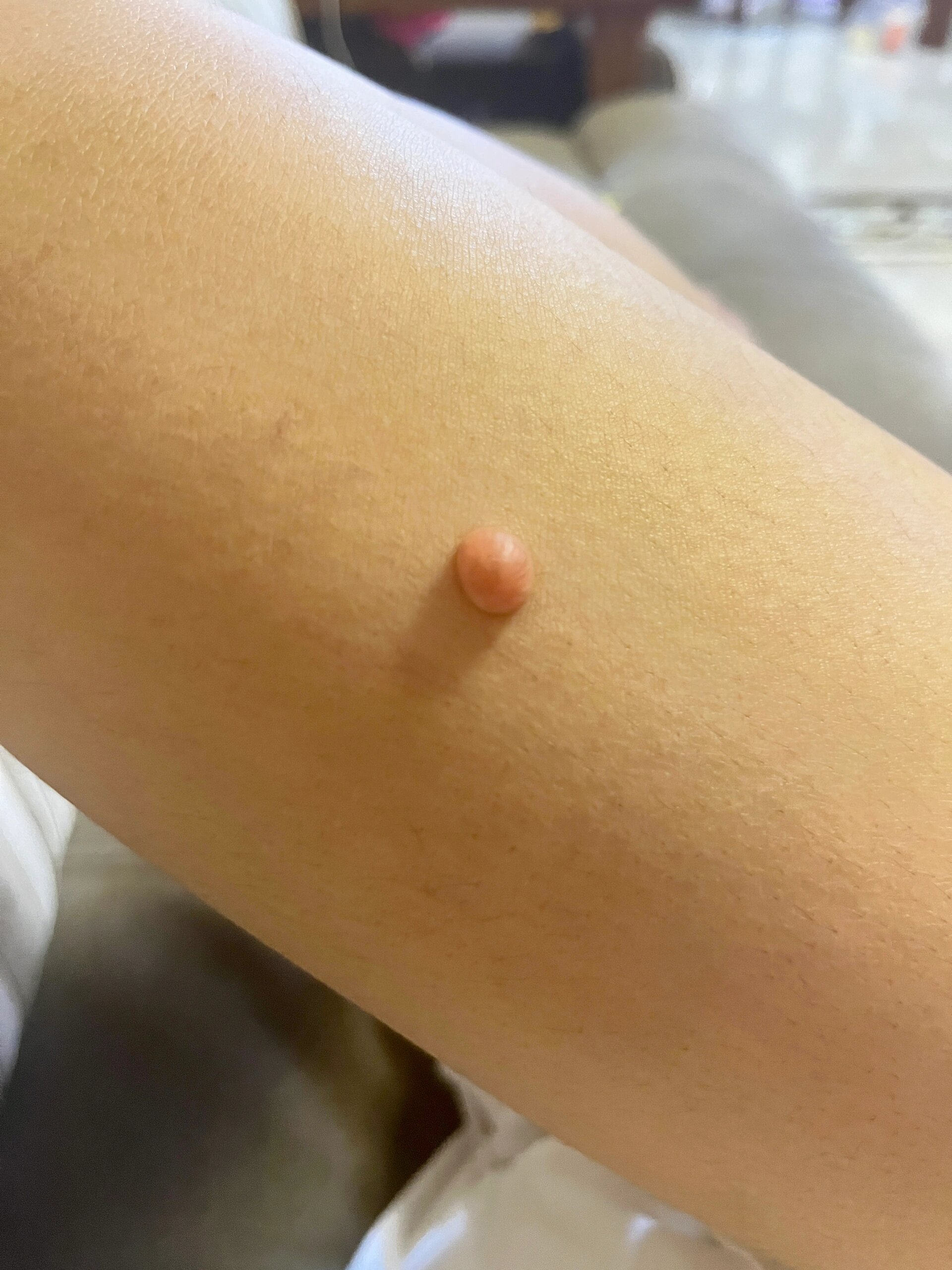 腿上的肉疙瘩