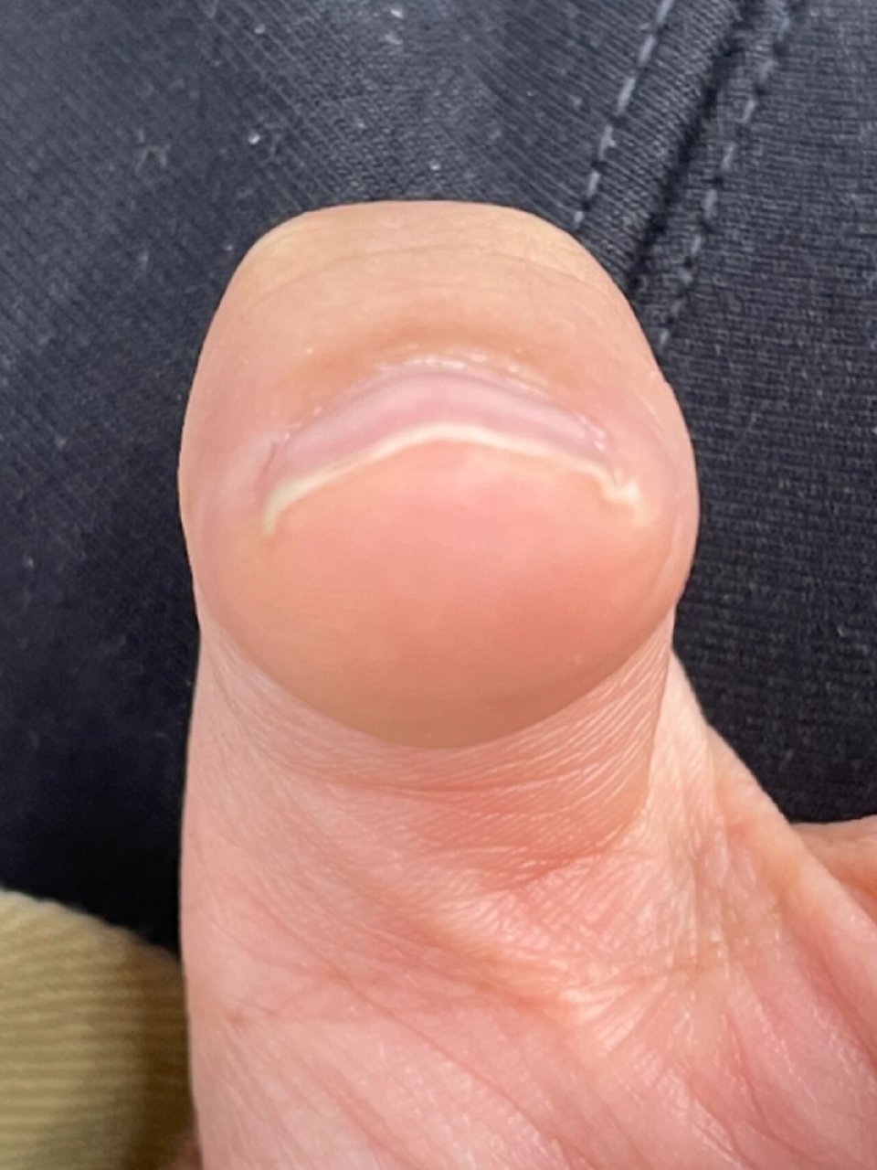 大拇指长成波浪型怎么办 横着看长成波浪型(像房子的盖92),俯视指甲
