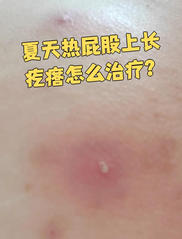 夏天热屁股上长疙瘩怎么治疗?