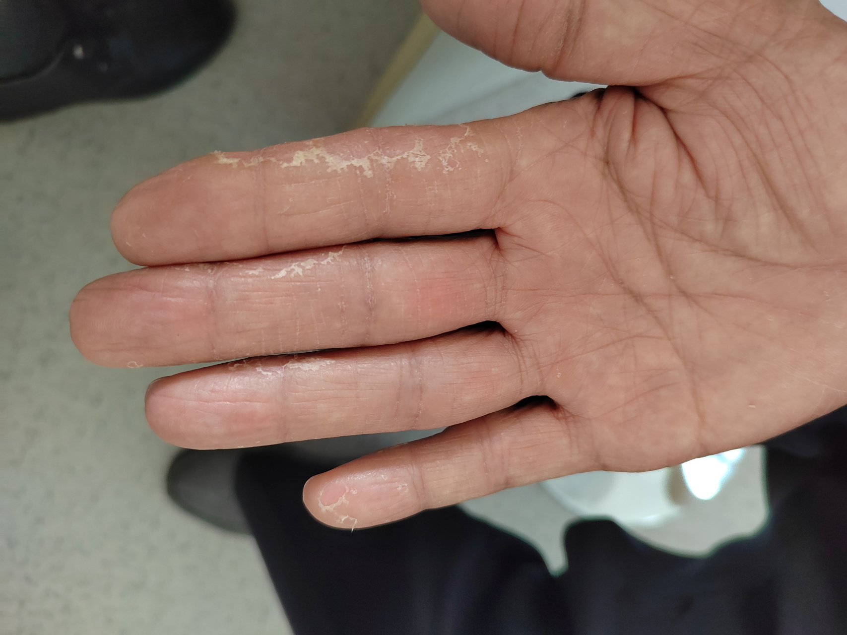 考虑汗疱疹和手癣可能.#解决皮肤问题专注皮肤美容##皮肤