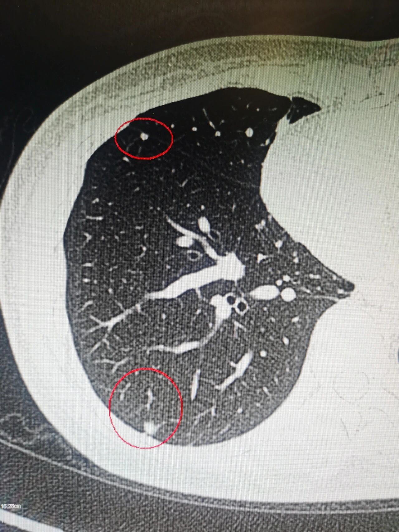 分享一种良性肺结节 湖南湘雅 分享良性 的中的一种肺内淋巴结 ,一旦