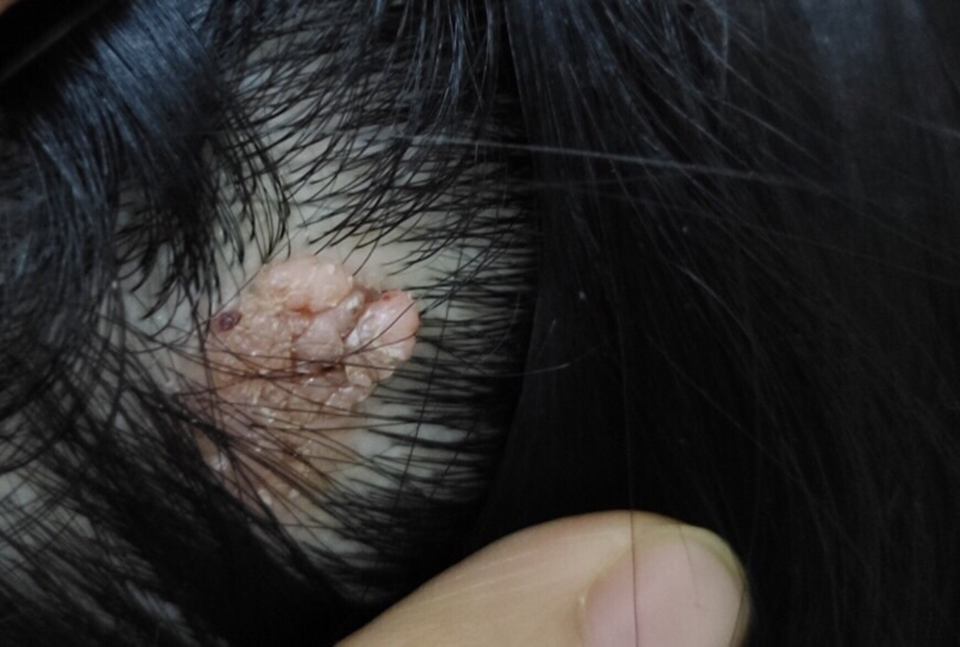 菜花状头皮疣切忌手欠!