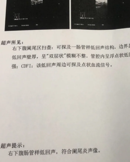 阑尾炎通常发生在右边