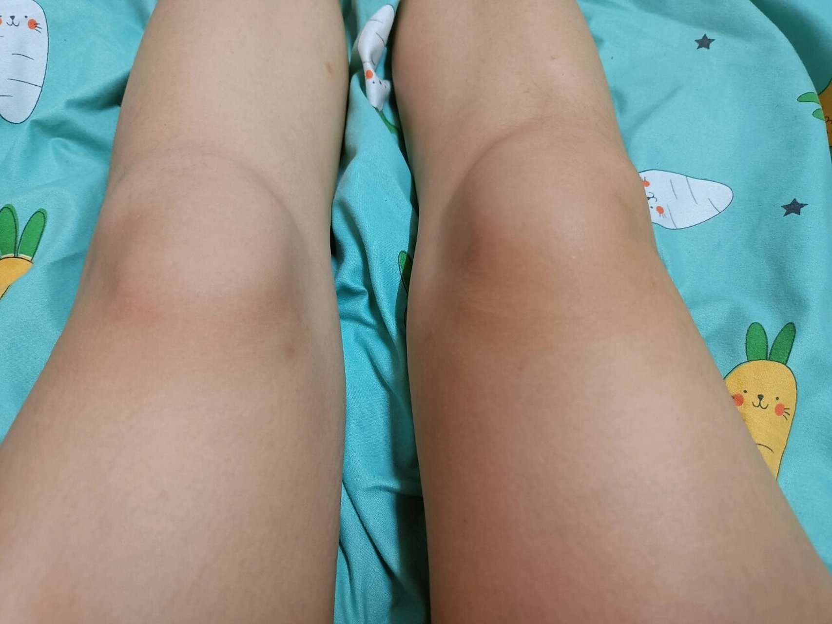 髌上滑囊炎 2018年夏天被车刮了摔到右腿膝盖 当时拍了ct医生说没什么