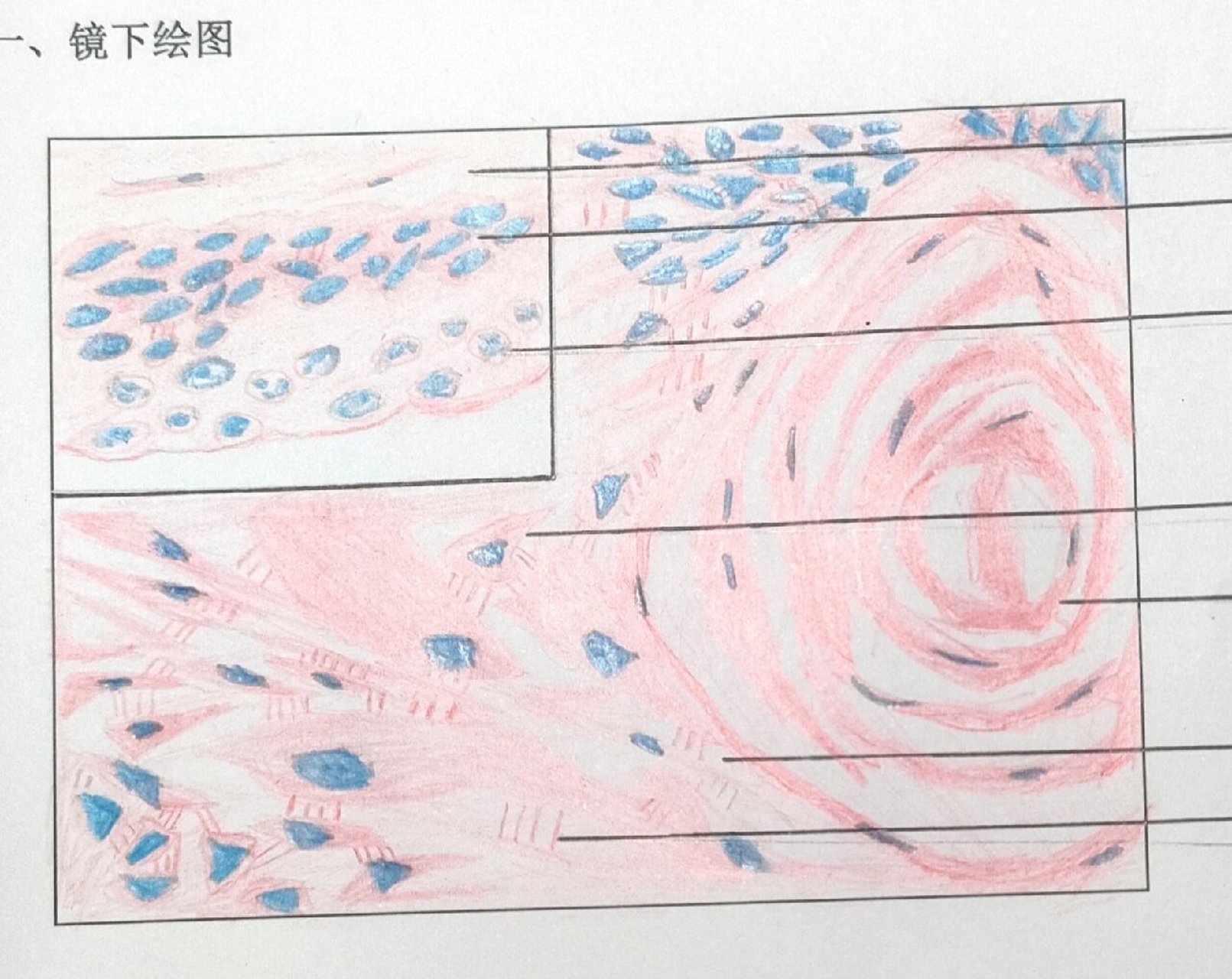 病理绘图 鳞状上皮细胞癌(高分化) 癌巢,角化珠,细胞间桥08