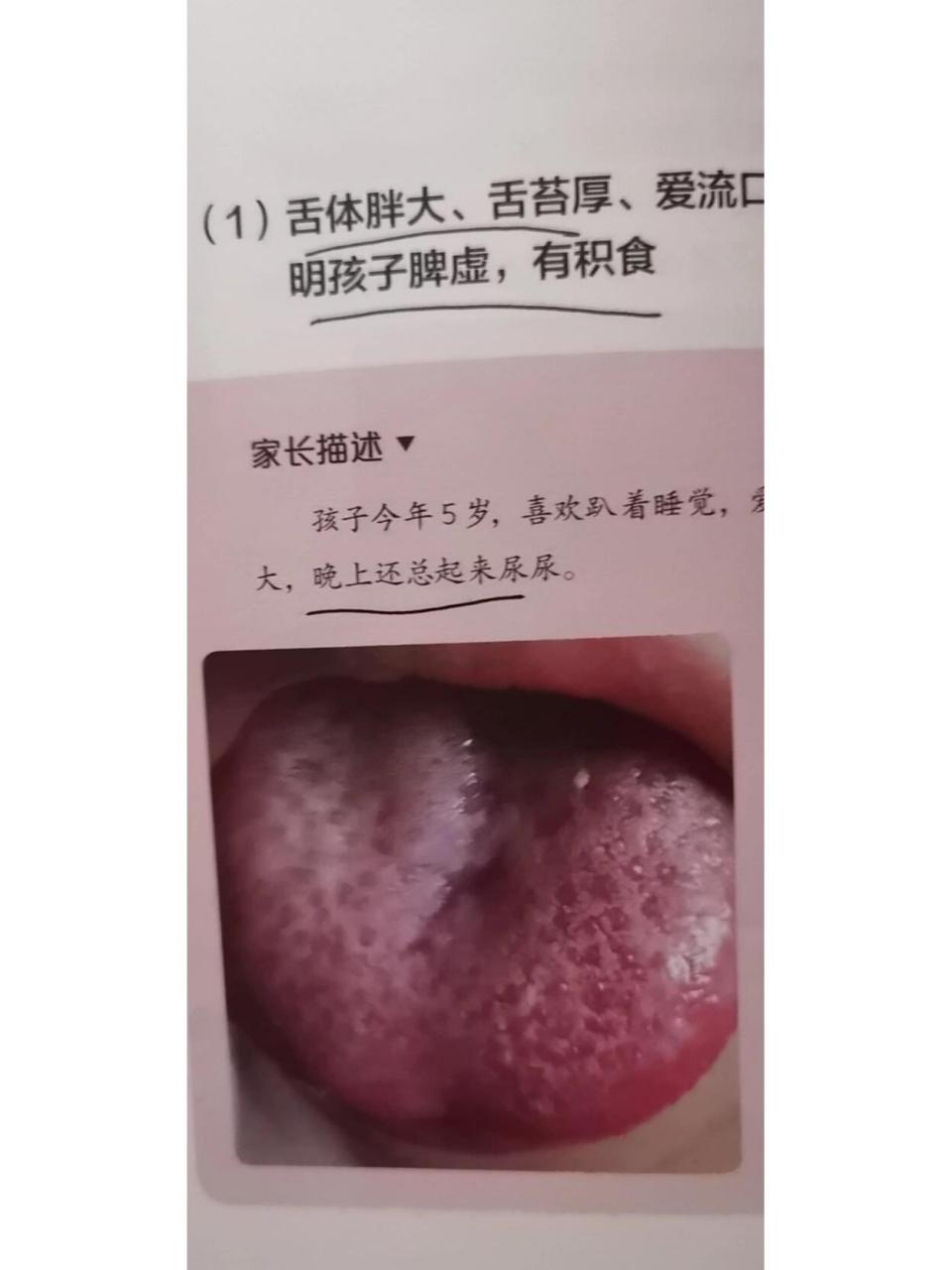 脾胃|| 舌头肿大 案例:5岁,喜欢趴着睡觉,爱流口水,扁桃体容易发炎