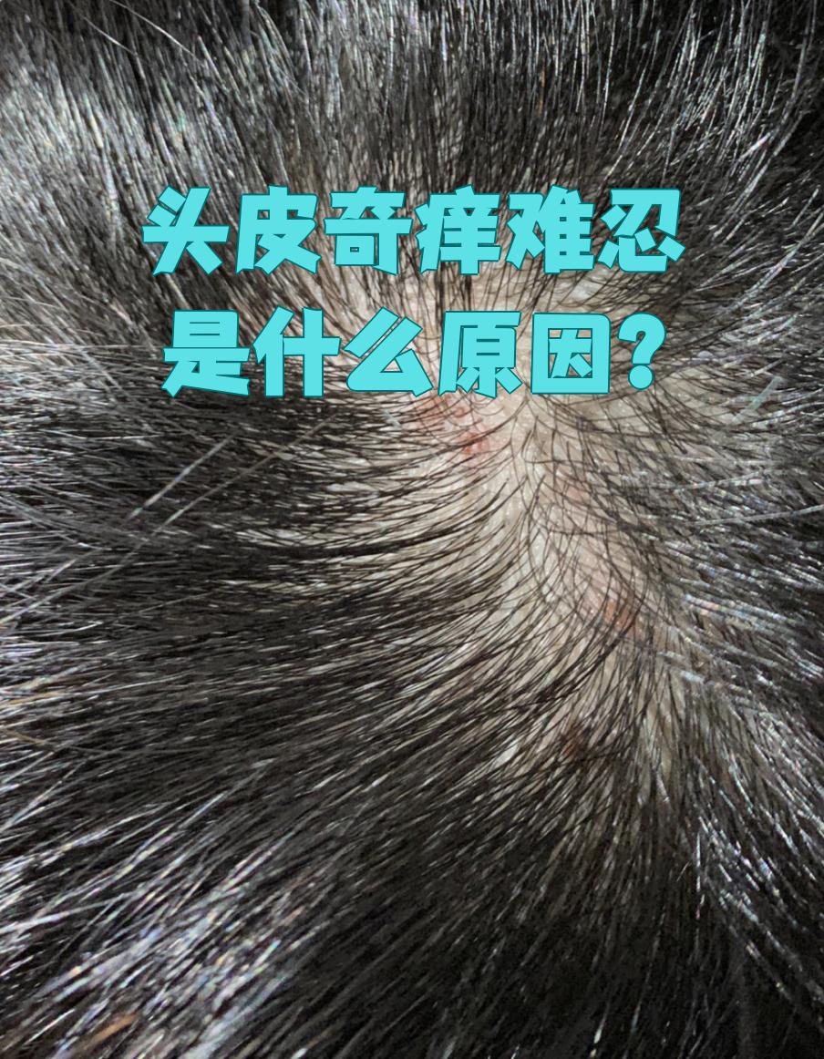 为什么头皮很痒还有头皮屑 为什么头皮很痒还有头皮屑