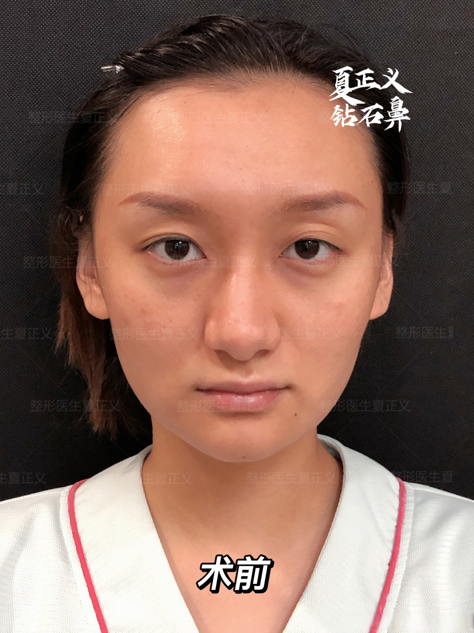 【肋骨鼻77鼻基底77膨体77宽鼻矫正】  她说:"感受到了高鼻梁