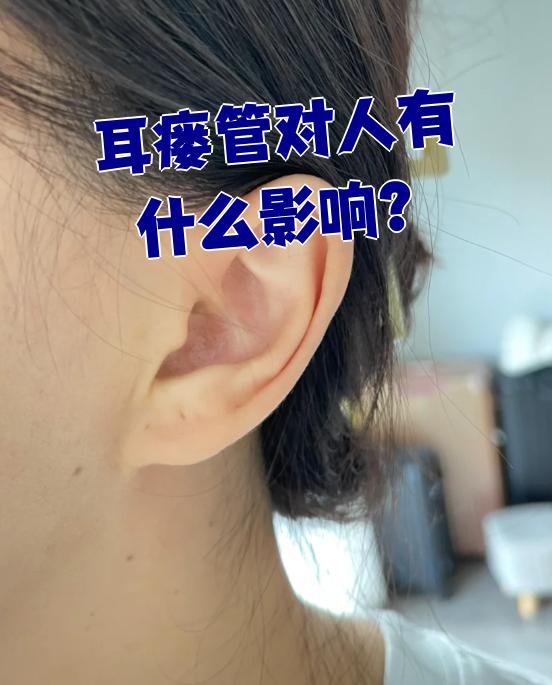 耳前瘘管是一种常见的先天性畸形.如果没有症状,通常不会影响健康