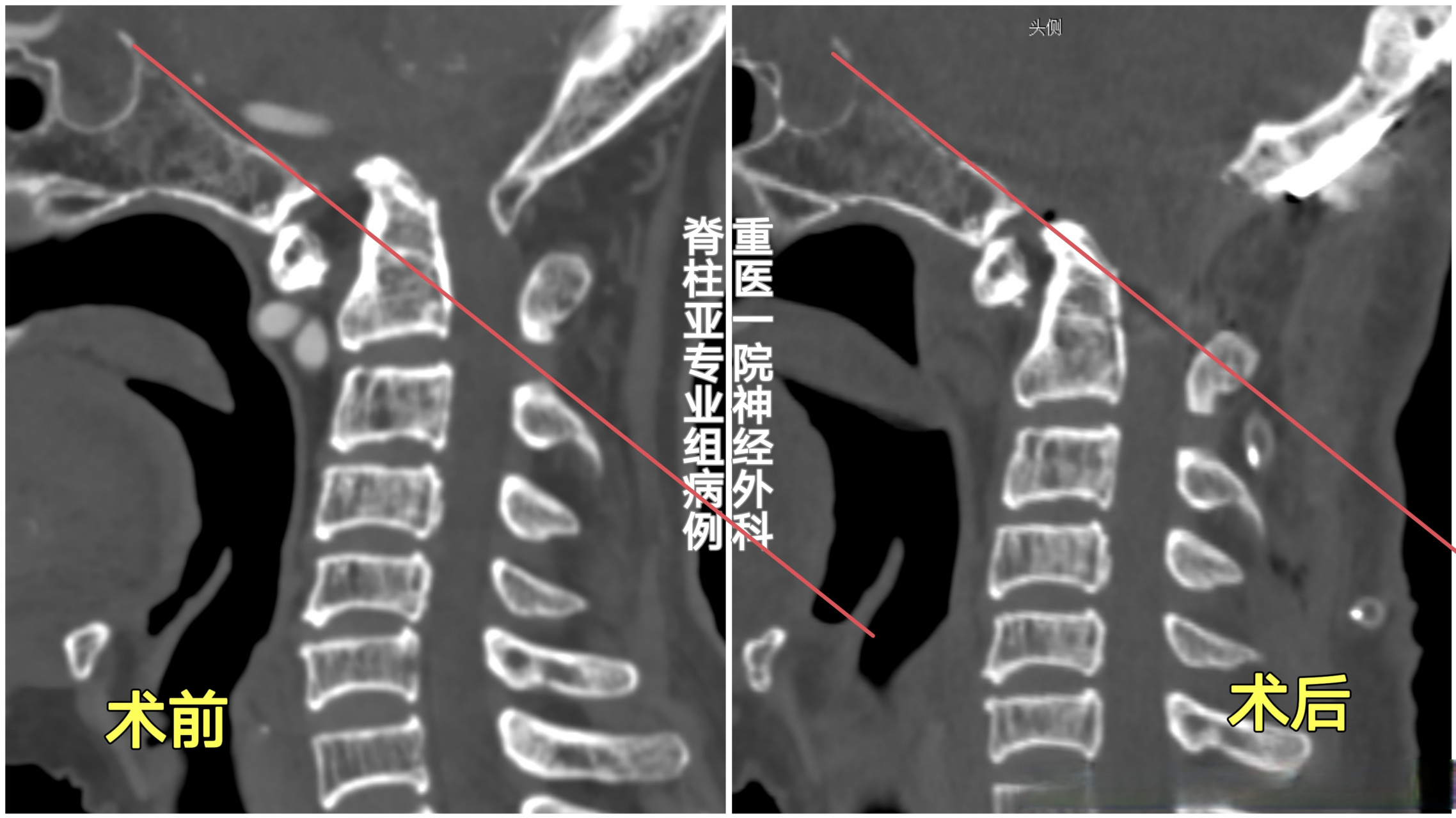 寰椎椎弓骨折图片