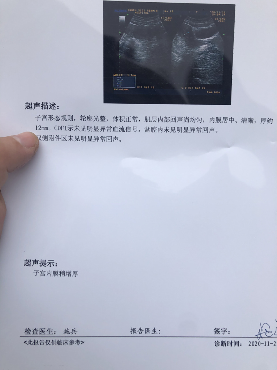 子宫内膜厚12mm会是癌症吗? 月经干净后12天检查的 内膜12算厚吗?