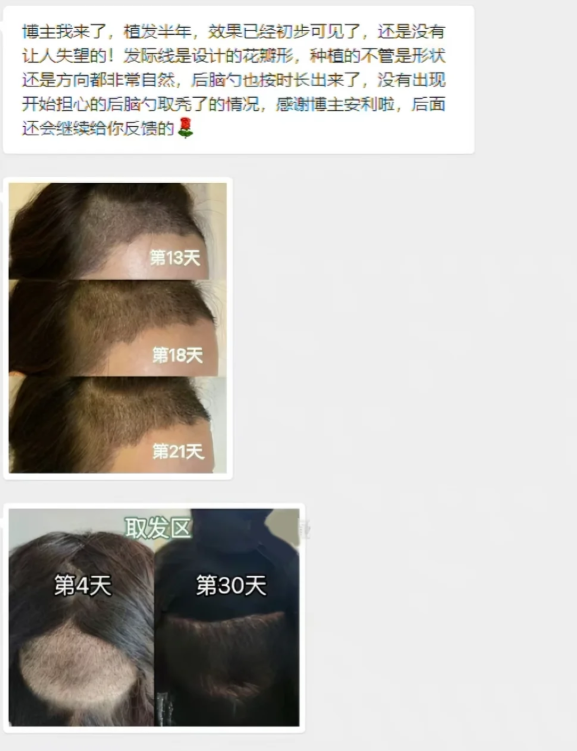 上海植发医院刘海(上海植发最好的医生)